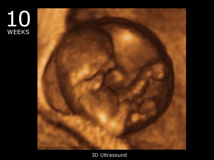 10 week ultrasound 3D