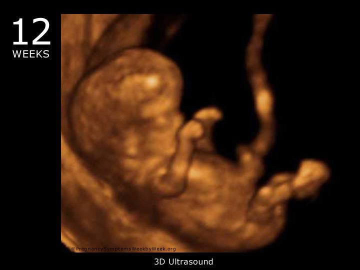 12 week ultrasound 3D