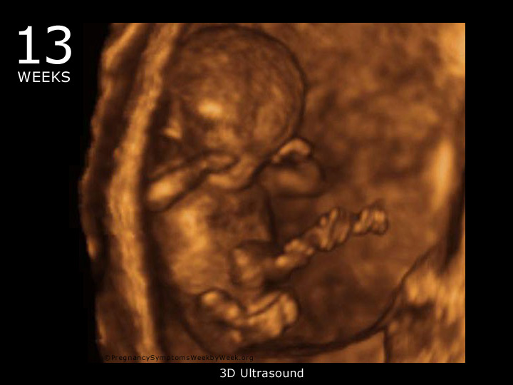 13 week ultrasound 3D