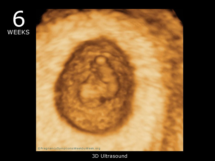 6 week ultrasound 3D