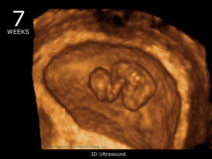 7 week ultrasound 3D