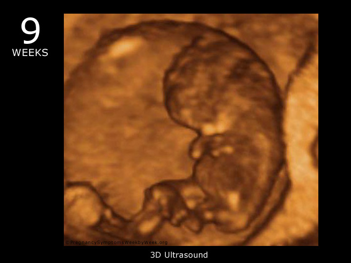 9 week ultrasound 3D